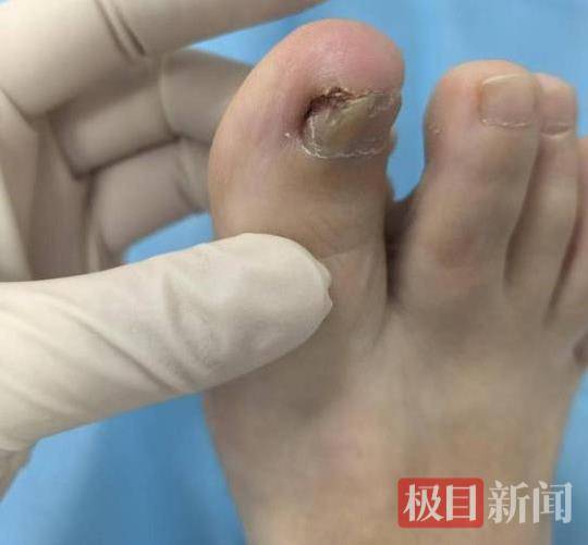 六旬女子被甲沟炎折磨了三年，专家30分钟手术解难题