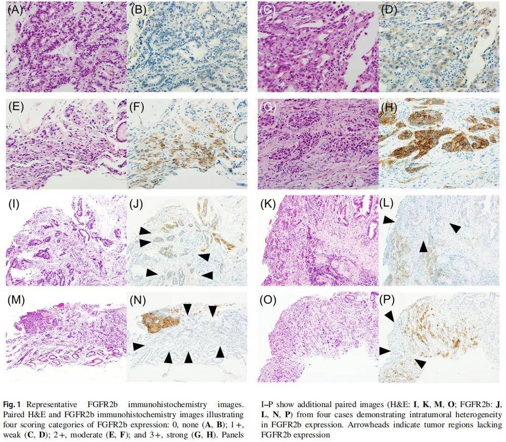 胃癌原发灶与腹膜转移灶的FGFR2b表达存在空间异质性,尽可能同时检测指导靶向治疗
