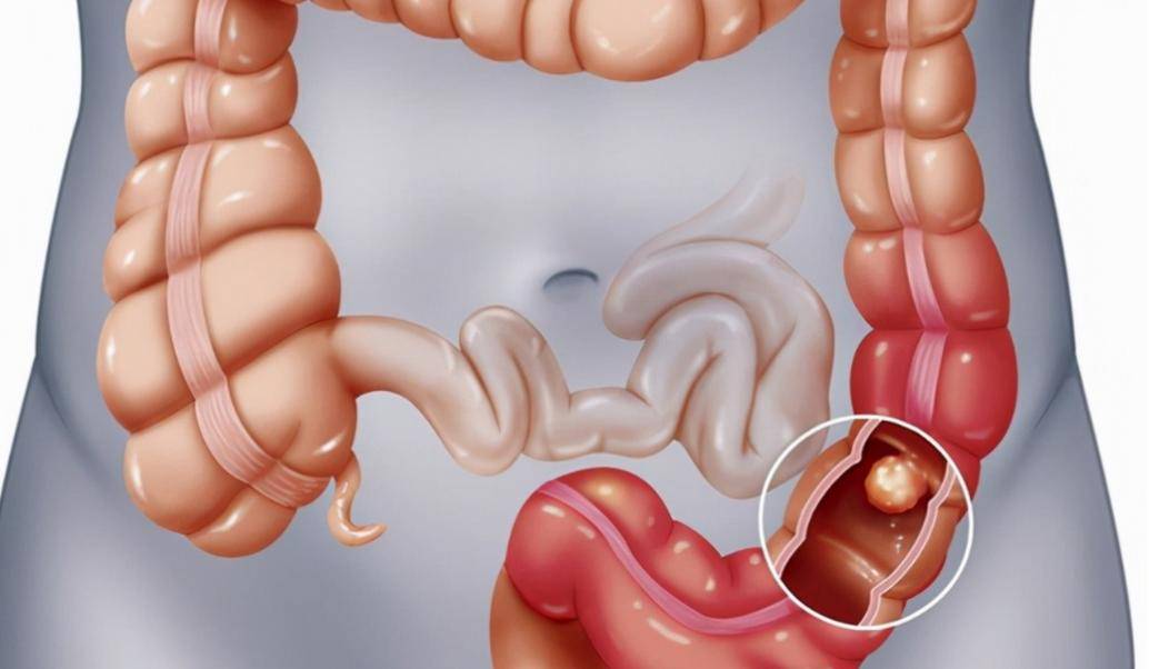 原创            浙大调研：肠息肉切除后，5种习惯务必改！否则后果堪忧