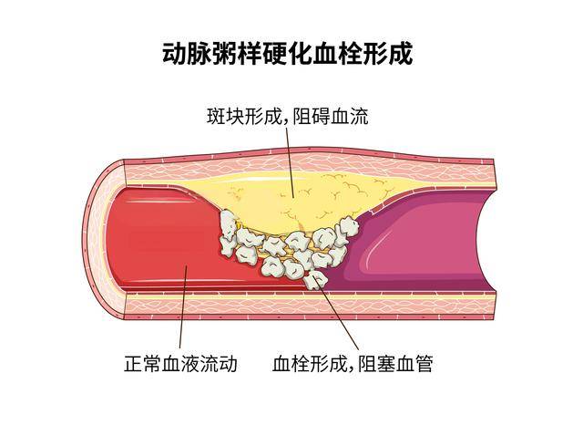 原创            不止坏胆固醇，这2血脂高也易致斑块破裂，医生提醒两类人风险大