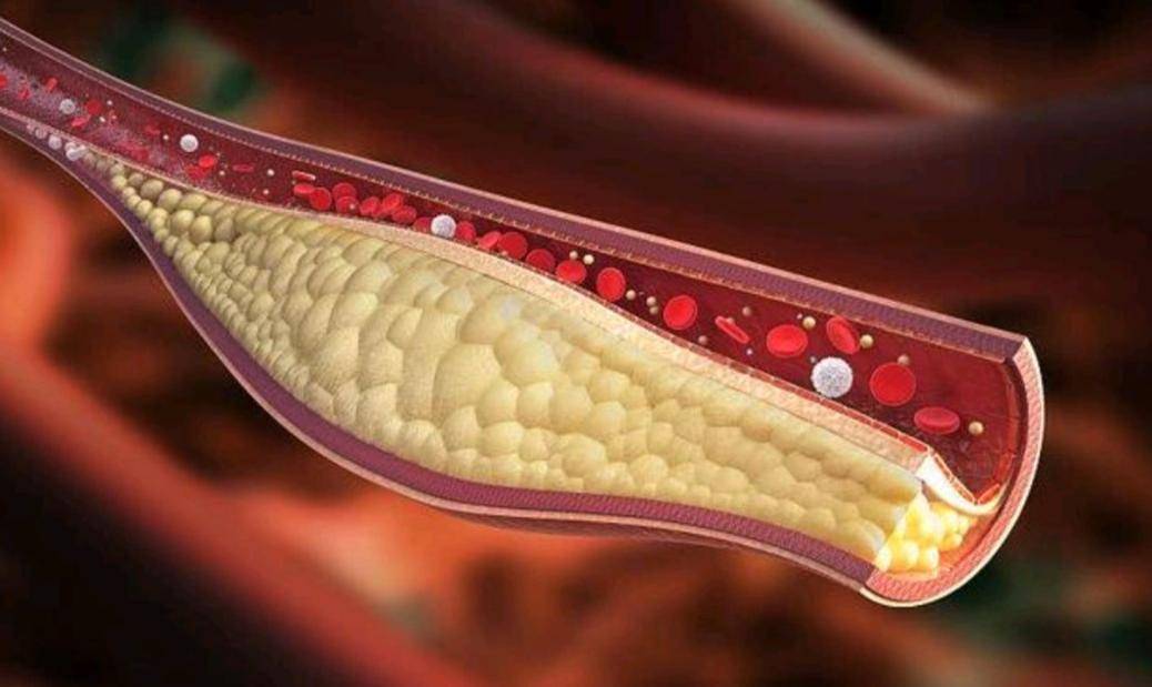 原创            医生：再严重的高血脂，没有这4个表现，不必过度担忧，照常饮食