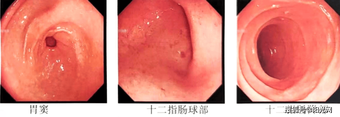 暴瘦40斤！一枚“隐身”的铁钉 一年难忍的剧痛