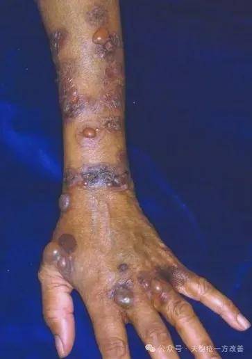 秋日浊毒扰 健脾祛湿愈天疱——内服外洗十日见转机