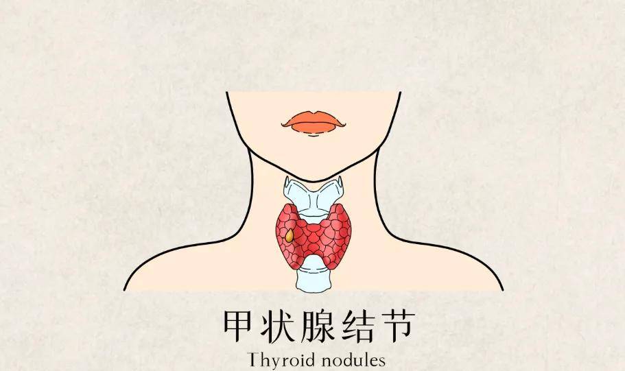 警惕！3 种白色食物会加速甲状腺结节癌变，其中一种你每天都吃，危害比盐还大