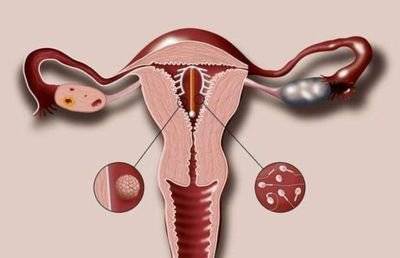 上环后怀孕引发的妇科疾病及相关症状