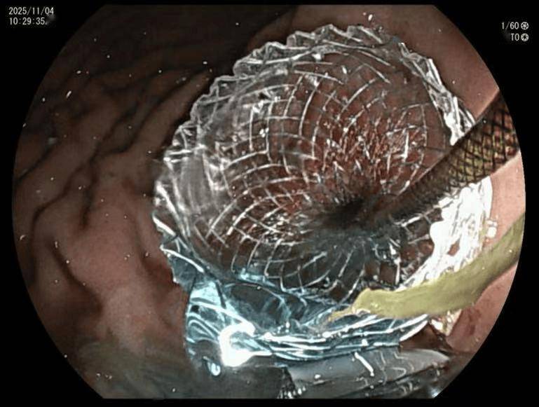 肿瘤堵住胃无法进食？北医三院消化科“另辟蹊径”重建食物通道