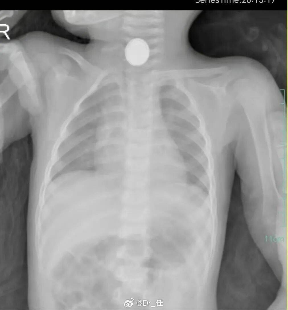 15 分钟就能灼伤孩子！家里这种「小圆片」千万要收好