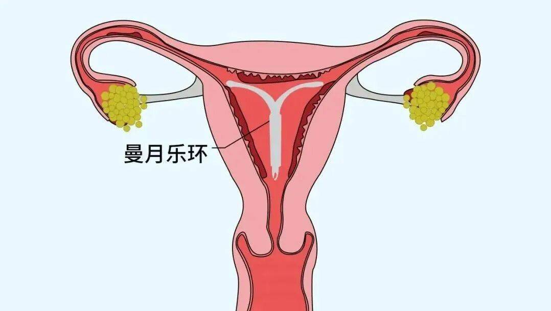 放置曼月乐环后总出血？别慌，先搞懂这3件事