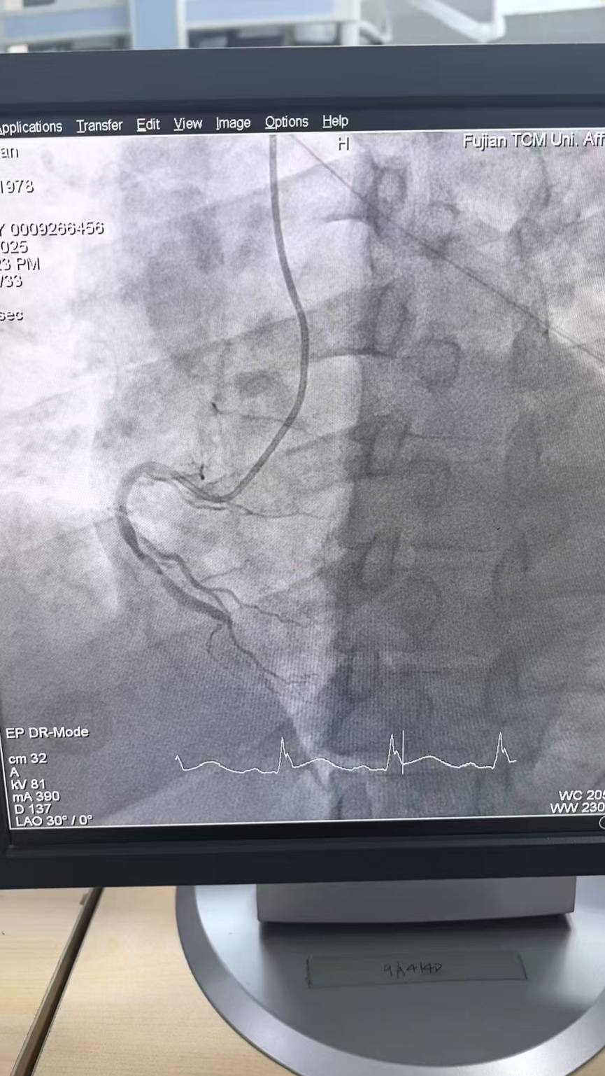 才47岁！福州男子突发心梗！医生：这几天高发