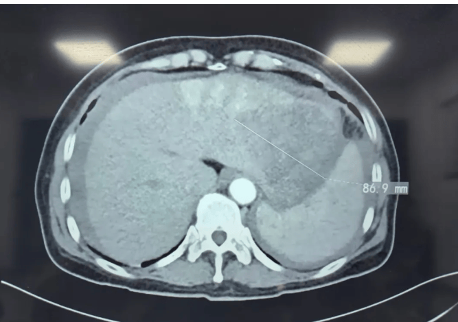 肝癌破裂出血引发剧烈腹痛