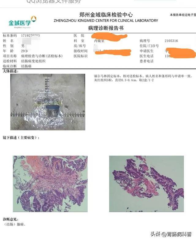 29岁，进展期肠癌！肠癌虽凶险却最容易预防！这些人要及时做肠镜