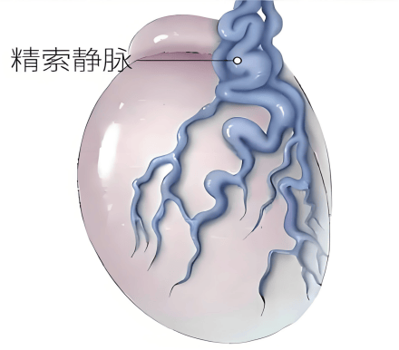 别忽视“蛋蛋”的隐形杀手--精索静脉曲张