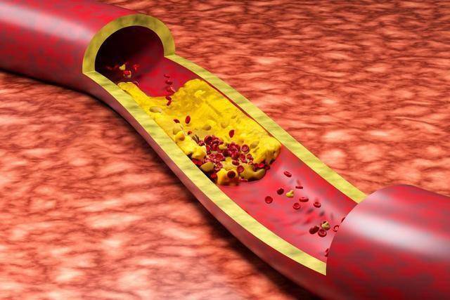 科普 | 降脂药：守护血管健康的“清道夫”