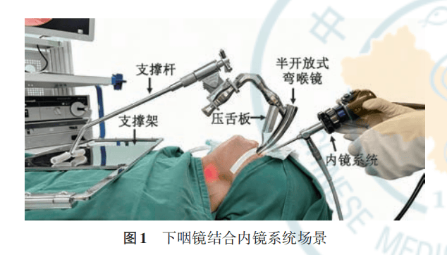继续教育园地 | 环后癌的内镜诊治：下咽镜技术的临床应用
