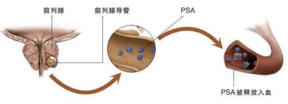 【健康科普】体检单上的“PSA”：读懂前列腺特异性抗原检测，守护男性健康