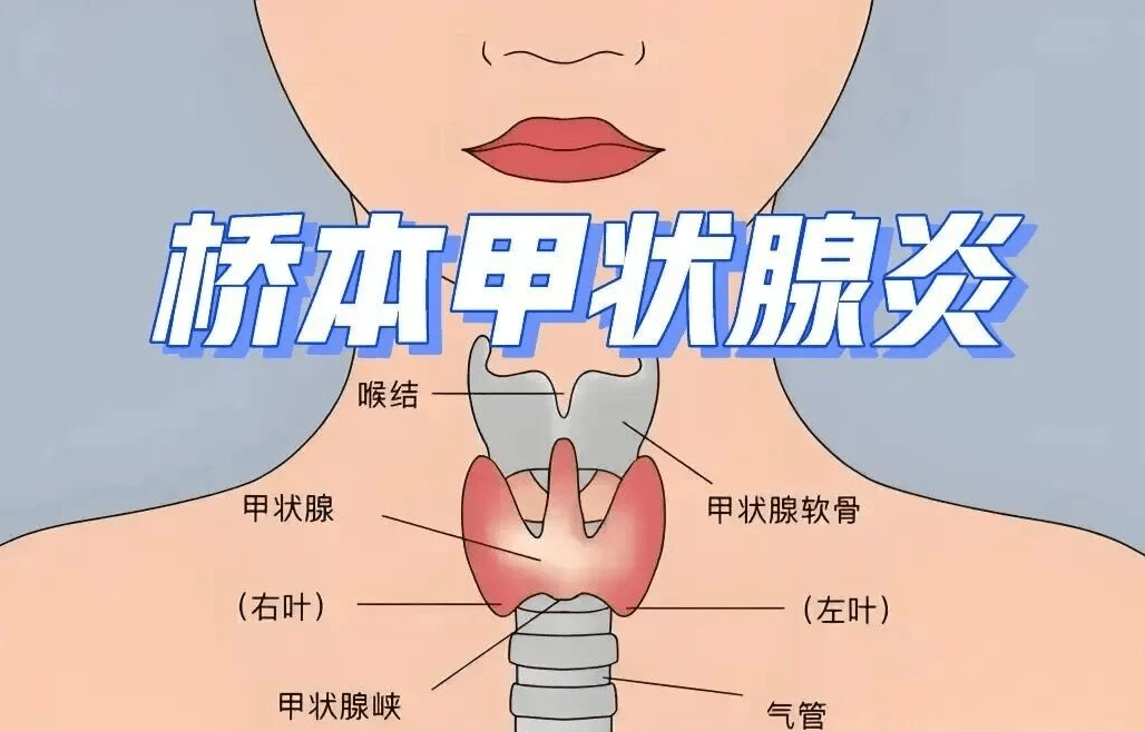 桥本甲状腺炎，西安甲康提醒不想抗体升高，这5件事不能做！