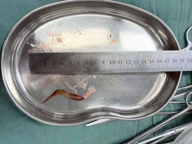 男子甲鱼骨卡喉吞饭“自救”致腹腔感染 医生紧急提醒