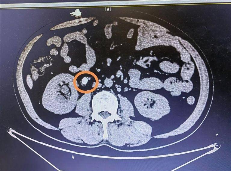 小石头藏大风险 医院激光碎石助患者转危为安