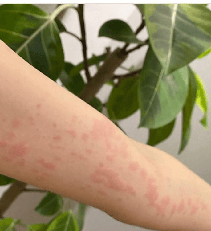 减肥失败三大盲点揭秘 银屑病治疗迎来新转机 专家解析关键突破