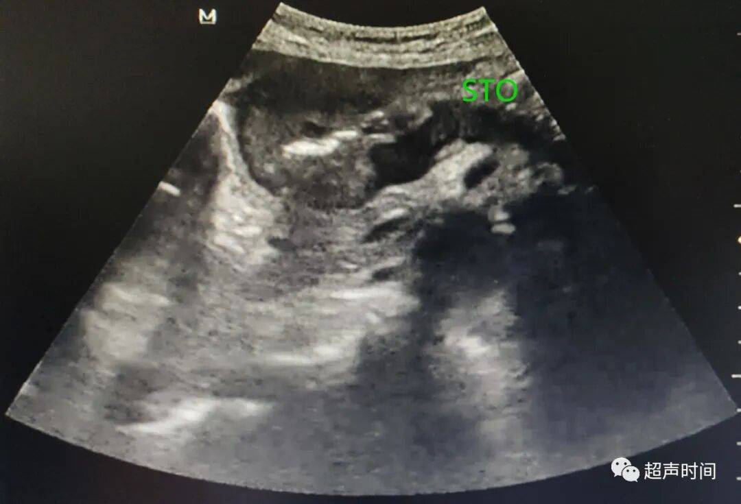 经典病例：遇到这样的胃窦癌，你能确诊吗？