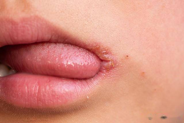 虚不受补？“温和版人参”刺五加：补虚调眠、强筋祛湿3种吃法