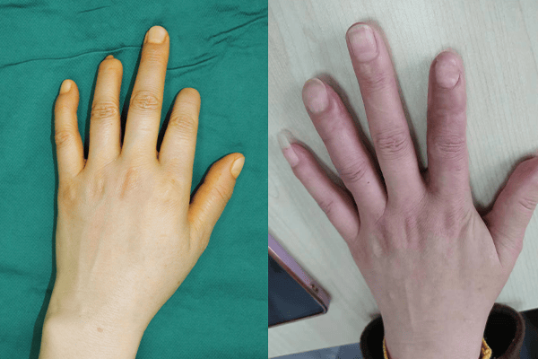 手指再造术后疤痕存在时间长吗？