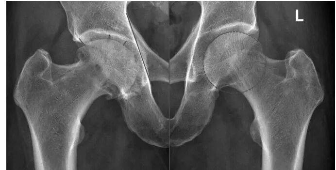 股骨头内有“空洞”，不一定是坏死