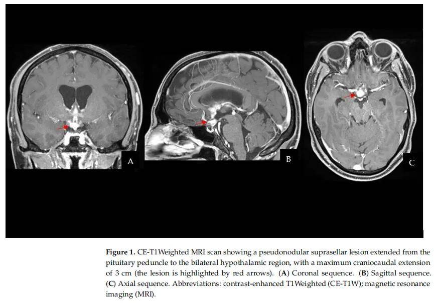 性腺和性腺外中枢神经系统生殖细胞肿瘤（GCTs）原发共存患者有哪些分子/病理/生理特征？