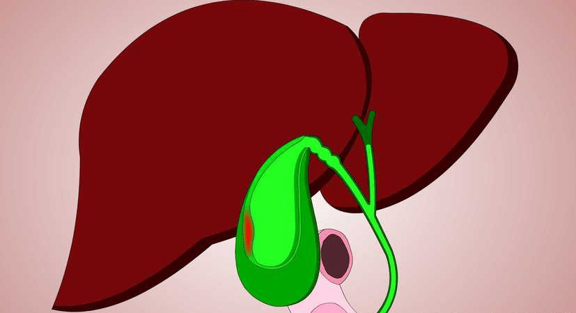 胆囊腺肌症：一种容易被忽视的胆囊“特殊病变”