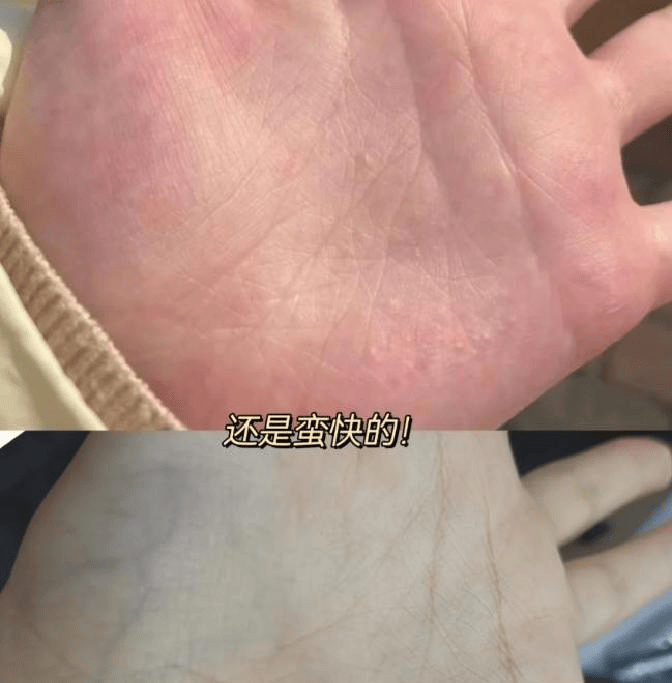 湿疹反复发作太痛苦 他坚持护理终获光滑肌 告别老树皮逆袭新生.mp4