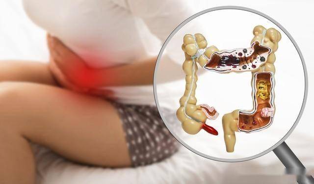 结肠炎总反复？腹泻、黏液便难缠？香连丸攻湿热型肠炎，根上清肠