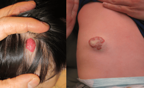 【科普】警惕！我院整形美容激光中心专家提醒：宝宝身上的“胎记”，可能是血管瘤在“伪装”