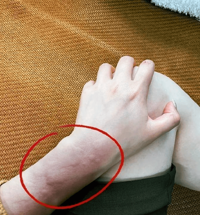 湿疹差点把我逼疯一个意外的尝试，竟让我找回光滑皮肤和自信