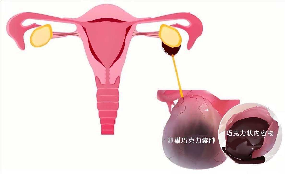 邱医生画给你看：两种巧囊治疗方式，如何影响你的生育能力？