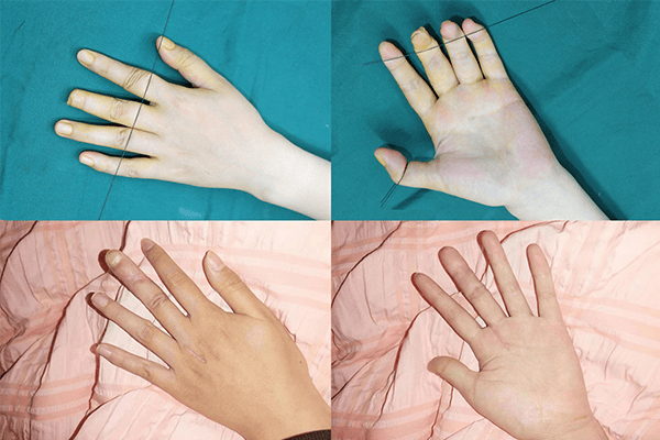 重建与移植，3D全形手指再造