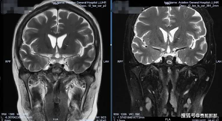 生命之战：肖庆主任精准引流技术破解真菌颅内感染困局