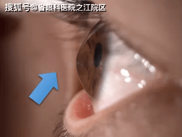 杭州之江眼科科普：总是揉眼睛，竟揉出了 “角膜变形”？
