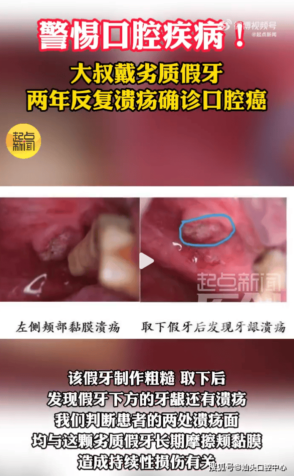 原创            62岁大叔溃疡两月不愈，一查竟是两种癌！元凶很多人嘴里都有