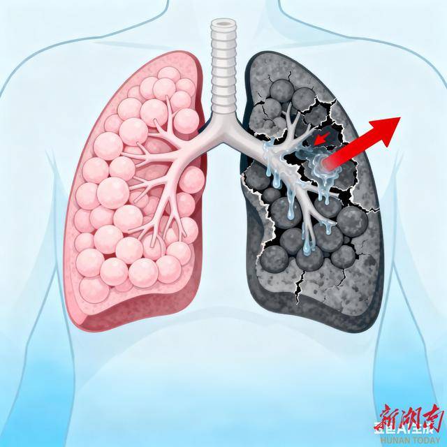呼吸不畅别硬扛！这些信号请立刻警惕