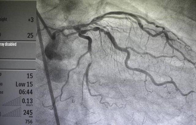 原创            医生提醒：一旦做了血管造影，这6件事要注意，别害自己！