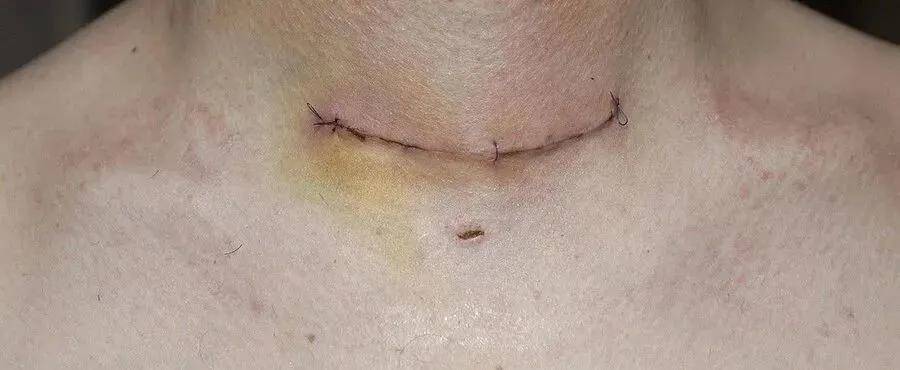 甲状腺癌半切，比全切更容易复发？医生说清了