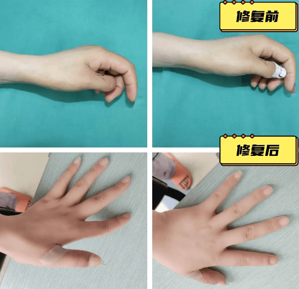 以匠心打底，以技术护航，黄威3D全形手指再造