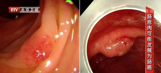 这种息肉几乎100%会癌变！40岁就该做检查了
