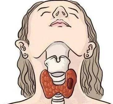 甲癌术后复发率有多高？医生揭秘：这3类人风险最高！