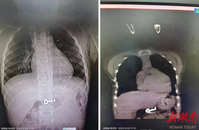 4岁女孩误吞钥匙，急诊胃镜化解危机