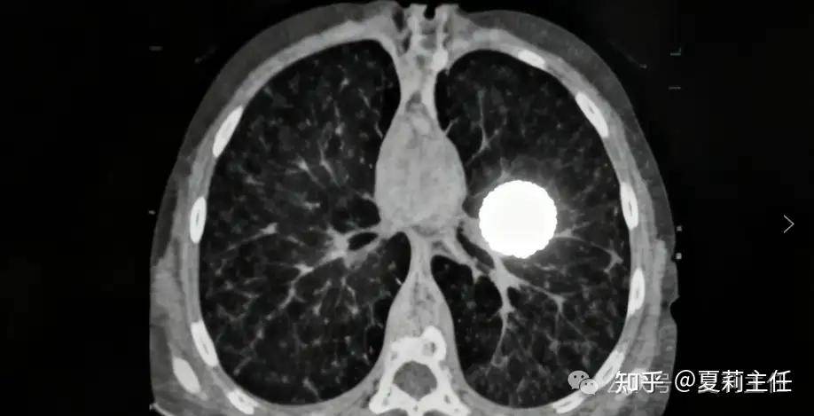 太凶险了！这3类肺癌 “恶化快” 还易转移，务必警惕！