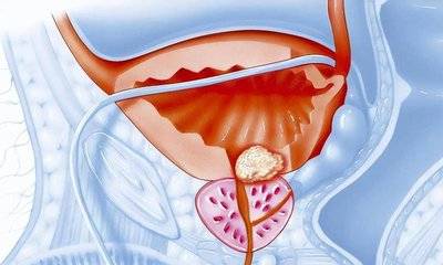 男人为什么会患前列腺钙化？有哪些预防方法？
