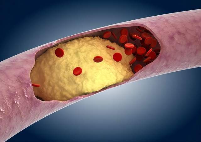 原创            胸口闷心脏出问题了？小心动脉粥样硬化，别等血管出现症状才行动