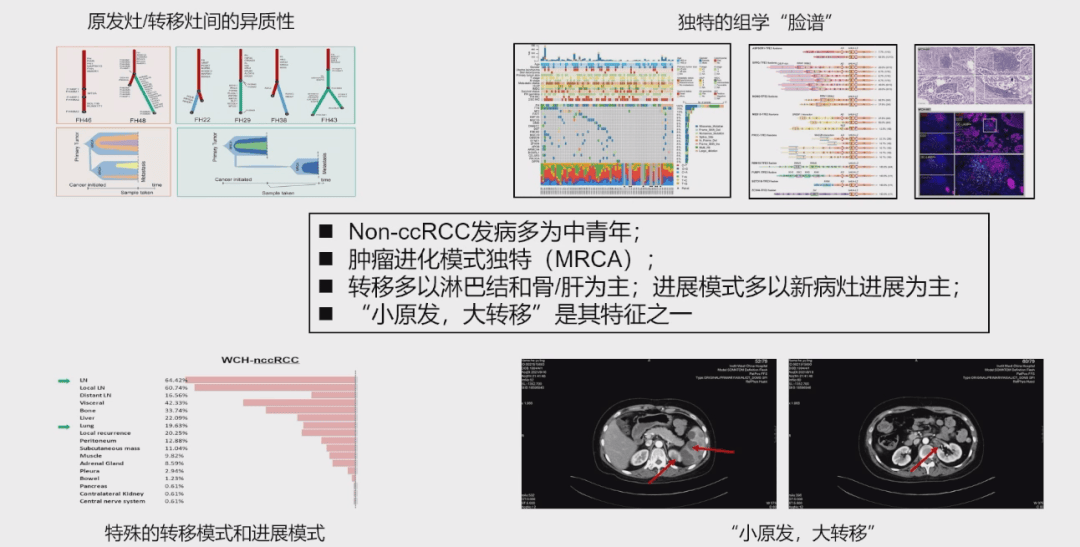 曾浩教授分享非透肾癌MDT诊疗策略与八大手术场景经验丨第十五届上海泌尿肿瘤学术大会