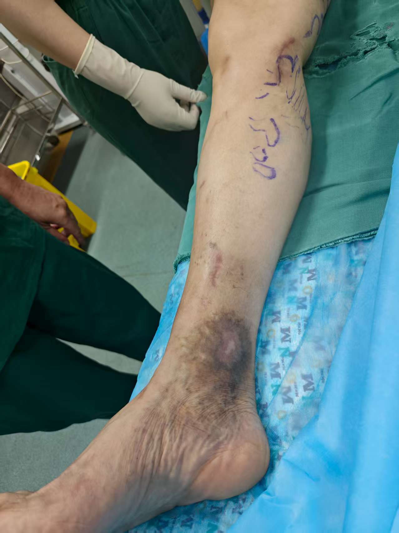 目前哪种技术治疗下肢静脉曲张效果好？